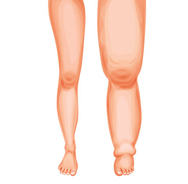 Edema foot. Swollen leg and ankle, vector lymphedema or lymphoedema disease of lymphatic system. Cartoon human feets comparison, healthy and swollen legs, fluid retention, lymph circulatory problems
