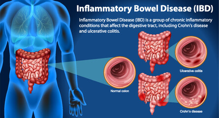 Inflammatory Bowel Disease (IBD) Infographic - obrazy, fototapety, plakaty