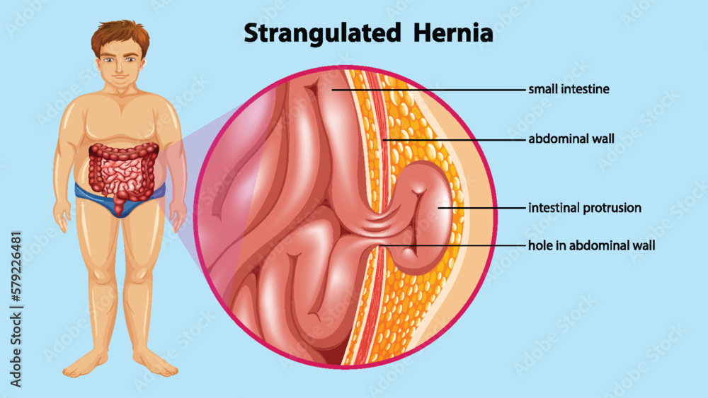 Sticker diagram showing strangulated hernia anatomy