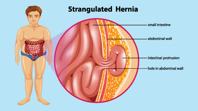 Diagram showing Strangulated Hernia Anatomy