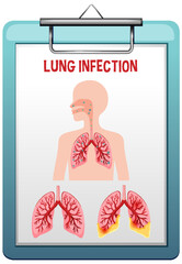 Lung infection pneumonia vector