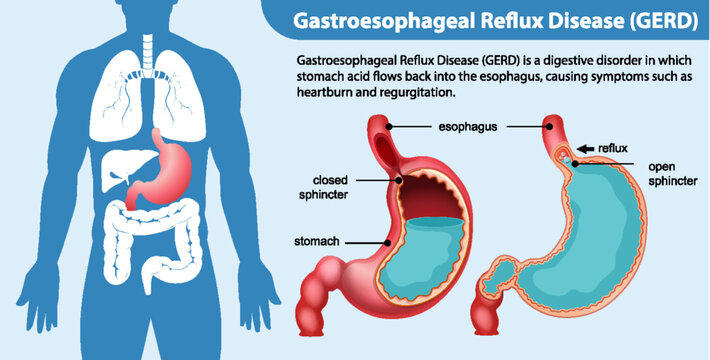 Gastroesophageal Reflux Disease (GERD) Diagram