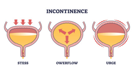 Incontinence problem with stress, owerflow and urge types outline diagram. Labeled educational medical disease with uncomfortable urine causes vector illustration. Body disorder and bladder illness. - obrazy, fototapety, plakaty