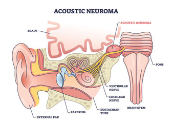 Acoustic neuroma as benign tumor near vestibular nerve outline diagram. Labeled educational ear structure with inner parts and medical disorder diagnosis vector illustration. Balance and hearing loss - obrazy, fototapety, plakaty