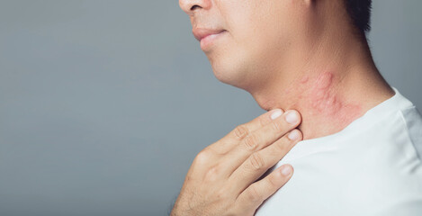 Man having red papules, itchy rash and scratching his neck. Skin allergy symptoms from ant biting....