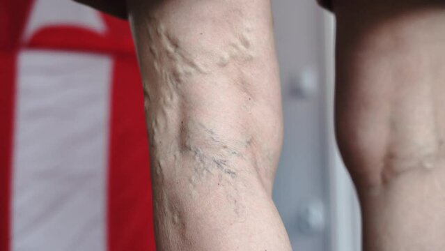 Mature woman legs close-up with varicose veins problem