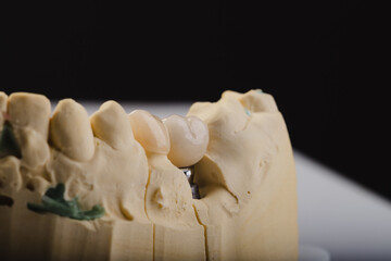 Implant-Supported Teeth: A Strong and Natural-Looking Solution for Missing Teeth