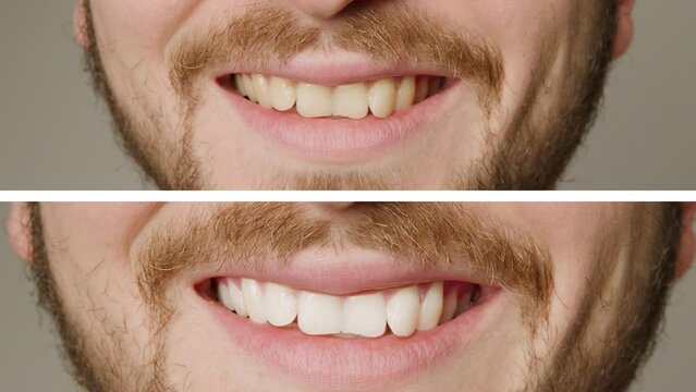 Collage of two superimposed pictures without background, before and after, without writing with man's teeth. Teeth whitening treatment. Man smiling broadly after teeth whitening procedure