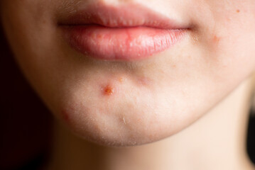 Naklejka premium Pimples on chin of teenager girl. Skin problems, adolescence. Close-up.