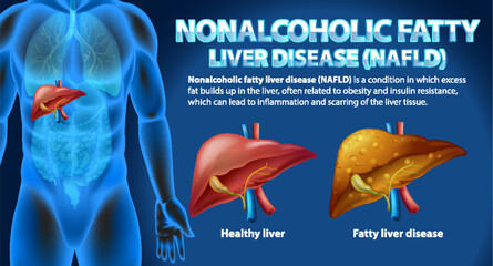 Nonalcoholic Fatty Liver Disease (NAFLD) - obrazy, fototapety, plakaty