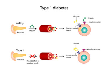 Diabetes mellitus type 1, pancreas's failure to produce enough insulin and type 2, cells fail to respond to insulin (Insulin resistance). Result in high blood glucose levels. Vector illustration - obrazy, fototapety, plakaty