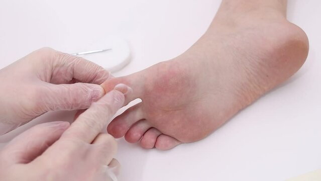 A dermatologist applies a cream for a wart on the big toe