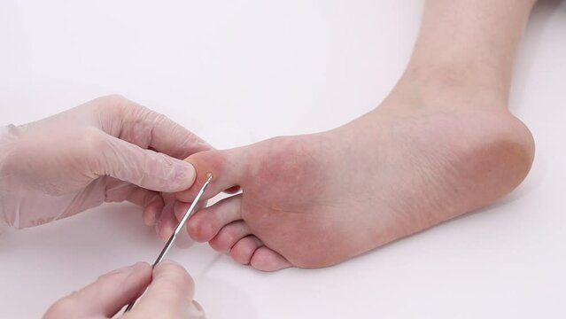 A doctor examines a patient's leg with a viral wart on his thumb