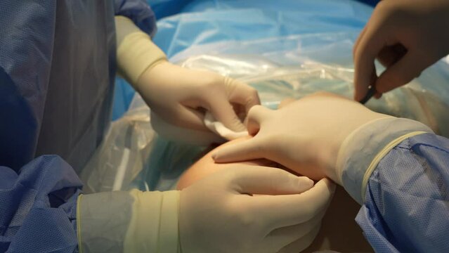 The doctor makes an incision with a scalpel on the girl's stomach, the assistant blots the blood with a gauze napkin. The process of a caesarean section close-up. High quality 4k footage