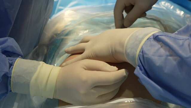The surgeon makes an incision with a scalpel on the girl's stomach. The process of a caesarean section close-up. High quality 4k footage