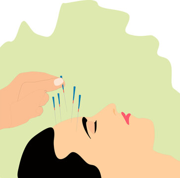 Vector of women undergoing  acupuncture treatment, needles inserted into skin of her forehead.