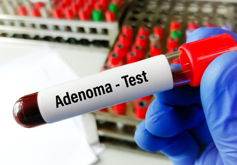 Adenoma blood test, polyps (called adenomas) have the potential to become cancerous.