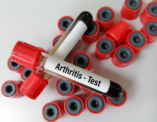 Blood sample tube for analysis of  Arthritis RA profile test in laboratory. Rheumatoid Arthritis.