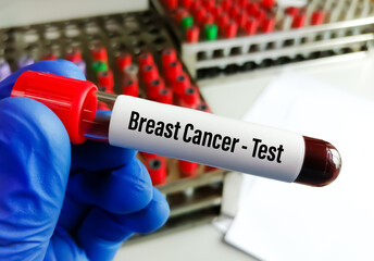 Scientist holding blood sample for Breast cancer test, CA-15.3.
