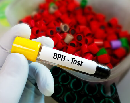 Blood sample Benign prostate hyperplasia (BPH), prostate health testing.