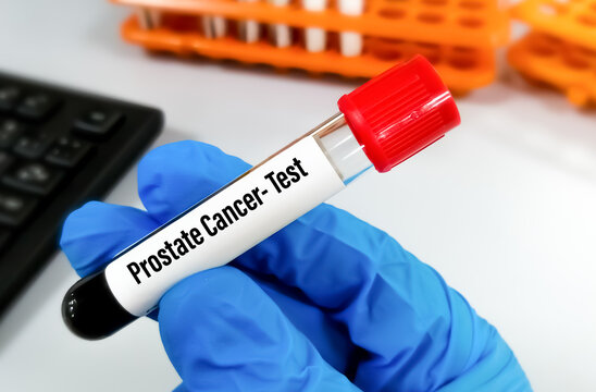 Blood sample tube for Prostate cancer test. Prostate health.