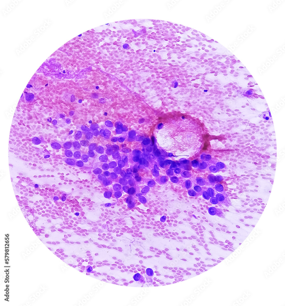 Wall mural Photomicrograph of fine needle aspiration (FNA) cytology of a pulmonary (lung) nodule showing adenocarcinoma, a type of non small cell carcinoma.