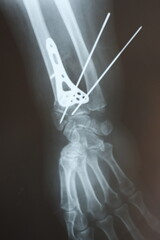 Surgical plates and instruments for osteosynthesis in case of bones  fractures	