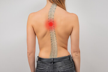 Woman with scoliosis of the spine. Curved woman's back. Severe pain in upper thoracic spine