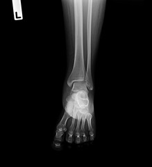 X-ray normal human of foot .