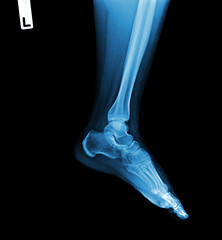 X-ray normal human of foot .