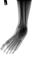 Naklejka premium X-ray normal human of foot .
