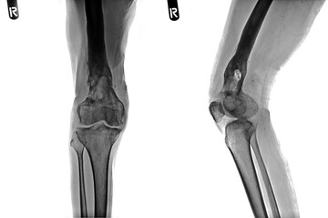 Knee Osteoarthritis. Film x-ray of osteoarthritis knee patient and artificial joint . Isolated...