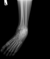 X-ray normal human of foot .