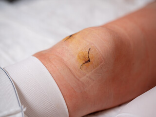 Arthroscopy or arthroscopic meniscectomy is a surgical suture on a woman's knee joint.