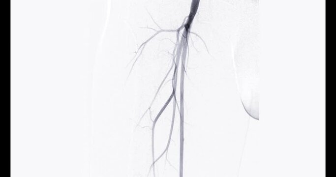 Femoral artery angiogram or angiography 