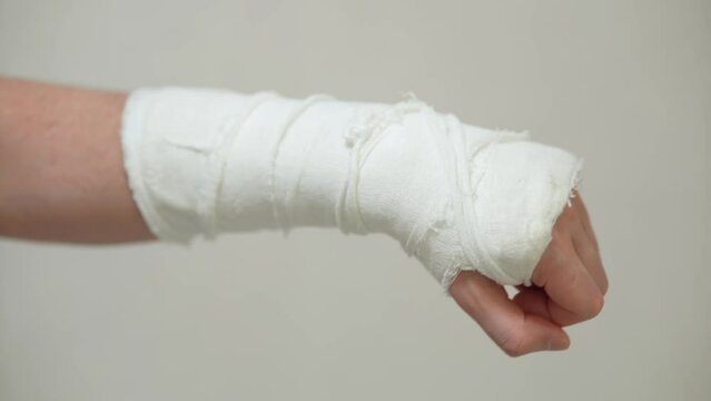 Man with plaster cast on arm. A broken arm in plaster.