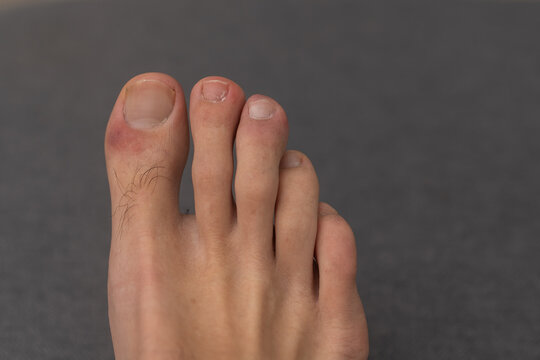 hair and pimples on men's toes