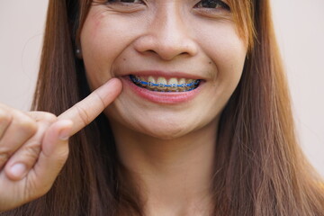 Asian woman pointing at mouth with braces