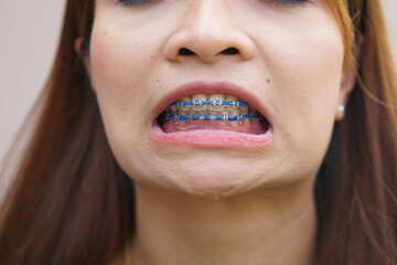 Fototapeta premium Asian woman straightening her teeth