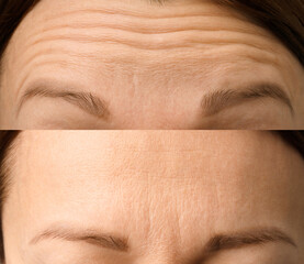 Female forehead with wrinkles - obrazy, fototapety, plakaty