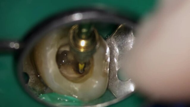 Dentist treats decay molar with medical drill and fills hole with water to rinse it. Macro footage of rotten tooth and doctor restoring it using mirror and sterile metal equipment. Oral cavity hygiene