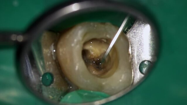 Dentist is filling hole in decay tooth with special liquid medicine with irrigator to disinfect from bacterium. Macro footage of doctor treating rotten chewing molar with mirror and probe in clinic