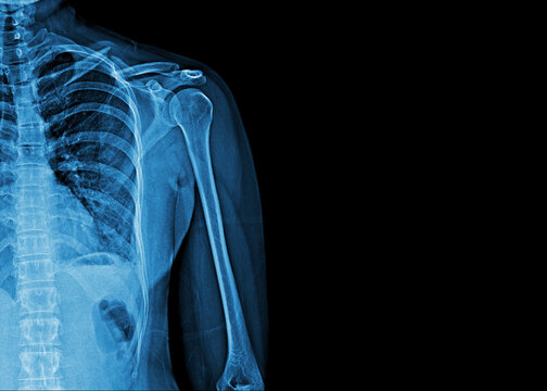 X-ray film of human shoulder