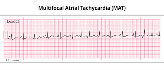 Multifocal Atrial Tachycardia (MAT) - 8 Second ECG Paper - Electrocardiography Vector Medical Illustration