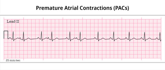 Premature Atrial Contractions (PACs) - Premature Atrial Complex (PAC) - 8 Second ECG Paper - Electrocardiography Vector Medical Illustration - obrazy, fototapety, plakaty