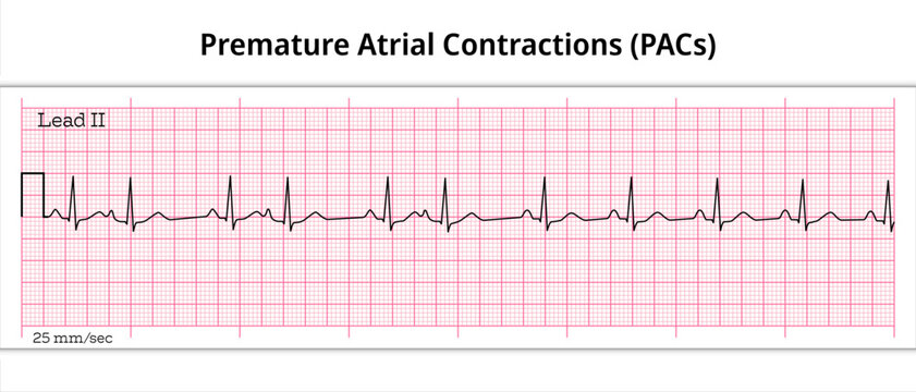 Premature Atrial Contractions (PACs) - Premature Atrial Complex (PAC) - 8 Second ECG Paper - Electrocardiography Vector Medical Illustration