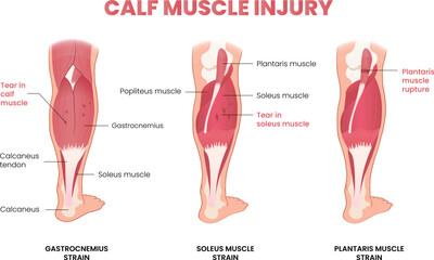 calf muscle injury infographic