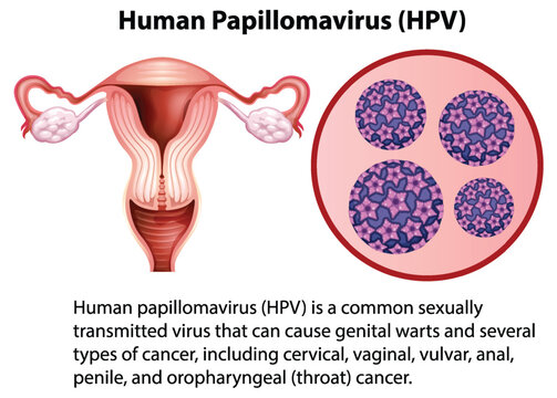 Human Papillomavirus with explanation
