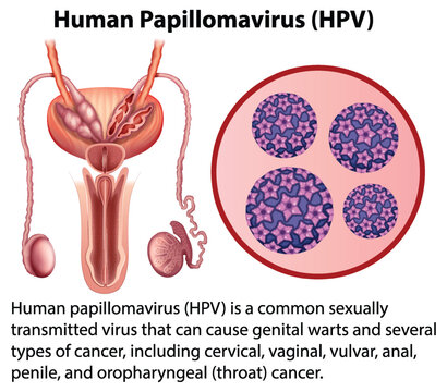 Human Papillomavirus with explanation