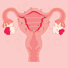 A pink illustration of a uterus with the nails in the middle